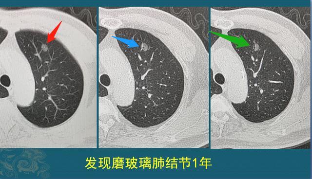 女子肺部磨玻璃结节癌变遭拒赔，健康保险与消费者权益的纠葛透视